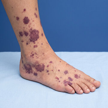Leg lesions featuring dark purple petechiae and purpura spots spread across the ankle and foot in a clinical setting.