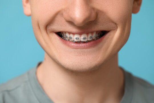 Smiling young man with dental braces on blue background, closeup