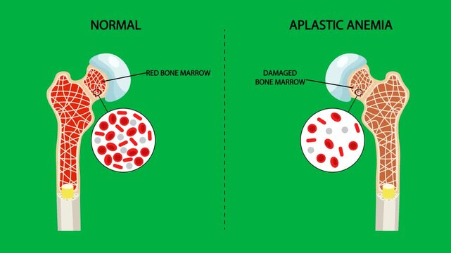 Medical vector animation comparing normal and aplastic anaemia bone marrow with reduced blood cell production on a green background. Educational hematology concept for awareness, diagnosis, treatment