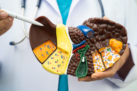 Cirrhosis, Liver cancer, fatty liver, Asian doctor with liver human model.