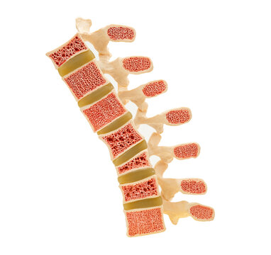 osteoporosis in back bone model isolated on white background with clipping path.