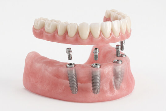 Modelo dental con implantes para pr&oacute;tesis fija