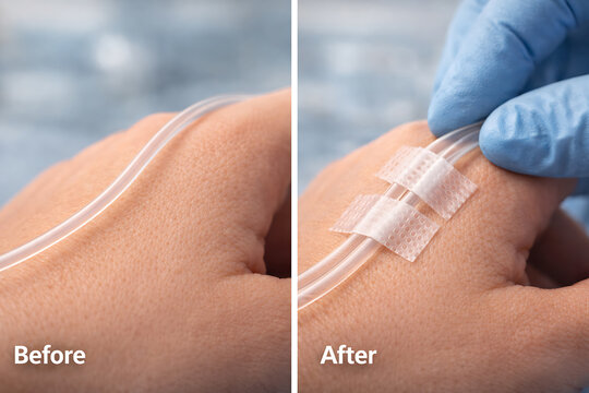 Before and after close up of hand intravenous catheter fixation with medical tape