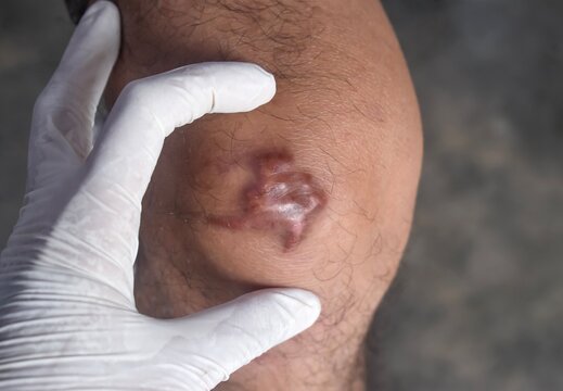 Keloid scar on the knee during a clinical dermatological assessment.