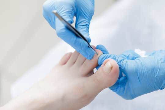 Podiatrist performing foot treatment on adult caucasian female with blue gloves