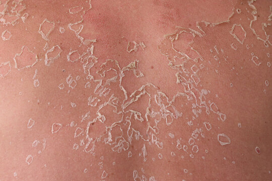 Peeling skin covers sunburned back. Dry flakes separate from irritated surface. Uneven texture follows sun exposure. Close detail emphasizes damaged epidermis. Skin texture forms medical background.