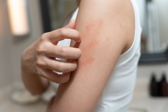 skin problem and beauty. woman scratch body has itchy skin from skin allergic, steroid allergy, sensitive skin, red from sunburn, chemical allergy, rash, insect bites, Seborrheic Dermatitis.