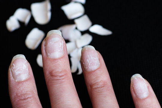 Close-up of brittle nails. Damage to the nail after using shellac or gel polish. Broken nails and shellac