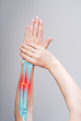Fracture with displaced of radius and ulna, broken arm, pain in his hand, painful area highlighted...