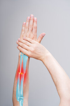 Fracture with displaced of radius and ulna, broken arm, pain in his hand, painful area highlighted in red with illustration anatomical bones