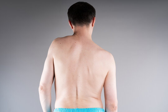 Poor posture, neck pain, cervical spine hernia and osteochondrosis, man with curvature of spine on gray background