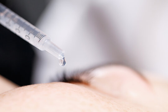 Syringe releasing droplet above closed eye in clinical setting for microneedling