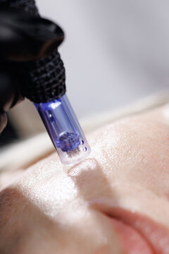 Closeup microneedling device contacting cheek skin in clinic cosmetic procedure