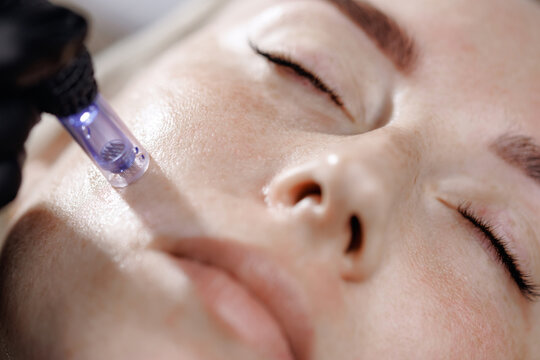 Woman receiving microneedling cosmetic procedure facial treatment in clinic