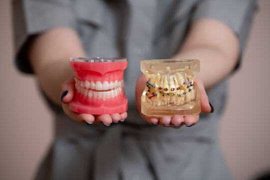 Close-up comparison of clear aligners and traditional braces using orthodontic dental models held by a dental professional.