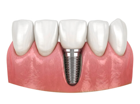 Implante Dent&aacute;rio Pino de A&ccedil;o com Coroa Dente da Frente