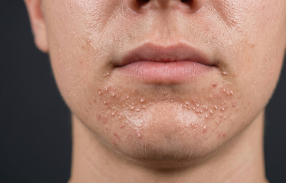 Close Up Detail of Congested Skin and Closed Comedones Bumps on Male Chin