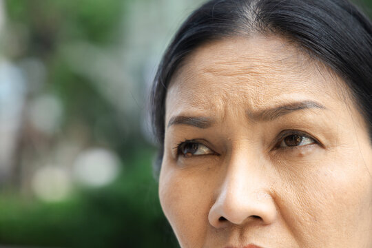 Middle aged Asian woman looking up, having eyelid bump condition, eye closeup shot