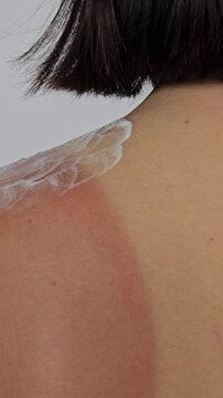 Applying sunscreen to prevent sunburn on the shoulder at the beach during a sunny day
