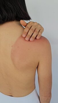 Sunburn treatment steps shown on back with hands applying lotion in a clear setting