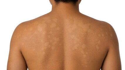 Naklejka premium Tinea Versicolor on Back Skin, Hypopigmented Fungal Skin Infection
