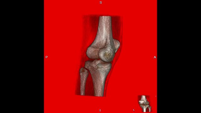 A 3D CT scan reconstruction demonstrating a bone tumor involving the knee region, with abnormal osseous changes around the knee joint. This medical imaging study is relevant to musculoskeletal radiolo