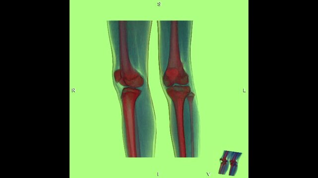 A 3D CT scan reconstruction demonstrating a bone tumor involving the knee region, with abnormal osseous changes around the knee joint. This medical imaging study is relevant to musculoskeletal radiolo