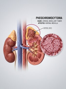 Medical Illustration of Pheochromocytoma Adrenal Medullary Tumor and Kidney Anatomy