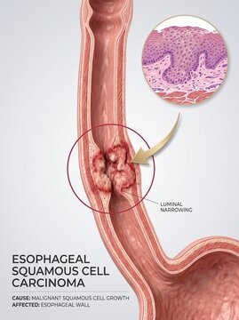 Medical Illustration of Esophageal Squamous Cell Carcinoma with Tumor Growth and Luminal Narrowing