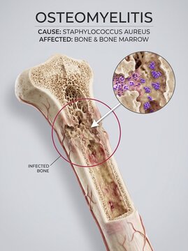 Medical Illustration of Osteomyelitis Bone Infection Caused by Staphylococcus Aureus