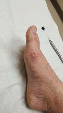 Diabetic foot pathology: cutaneous ulcer, sensory neuropathy, medical examination, monofilament test, vascular complication, dermal lesion, patient care, endocrine disease.