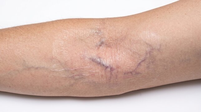 Visible superficial veins and spider telangiectasia scars on inner elbow crease