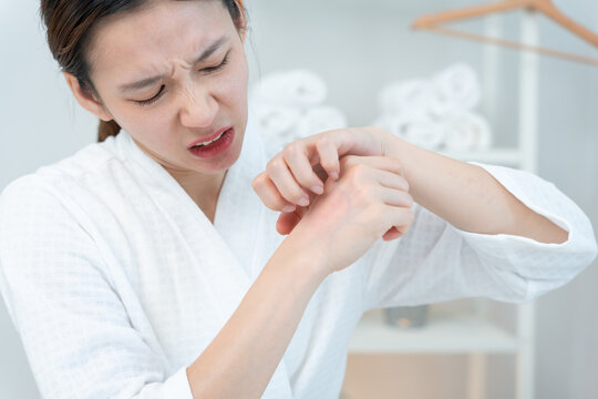 skin problem and beauty. Young woman scratch body has itchy skin from skin allergic, steroid allergy, sensitive skin, red from sunburn, chemical allergy, rash, insect bites, Seborrheic Dermatitis.