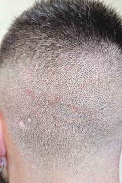 Close-up of shaved scalp with visible dandruff, dry flakes and peeling skin, detailed view of irritated scalp surface and short hair