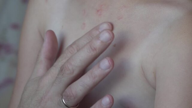 applying cream for lichen, dermatitis or chickenpox, Closeup of applying medical cream to skin rash or chickenpox.
