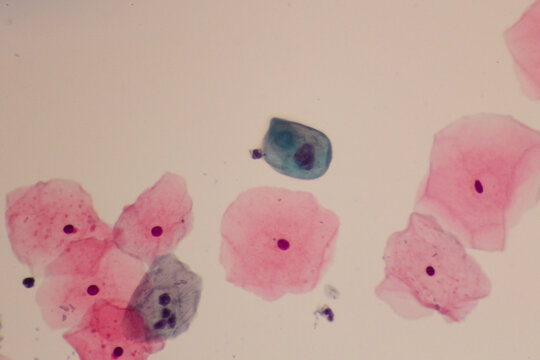 View in microscopic of abnormal human skin cells.Squamous epithelium cells.Superficial and intermediate epithelial cells.Cytology and pathology laboratory department.Magnification 400 X