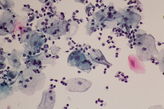 View in microscopic of abnormal human skin cells.Squamous epithelium cells.Superficial and intermediate epithelial cells.Cytology and pathology laboratory department.Magnification 400 X