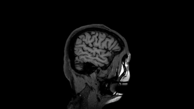 Axial MRI Scan Sequence Scrolling Through Human Brain and Cranial Anatomy
