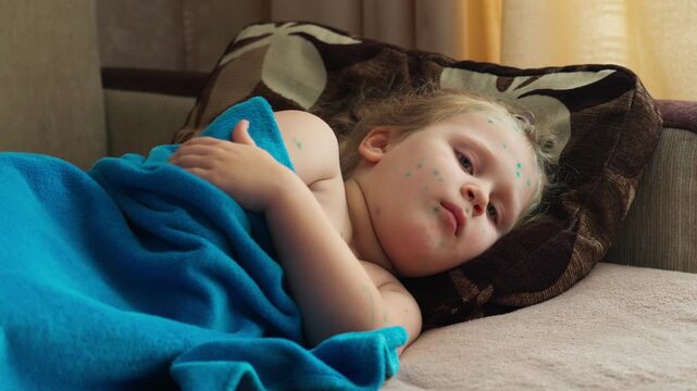A little girl with chickenpox lies sadly at home, covered with a blanket.  The child is in home isolation. Chicken pox.