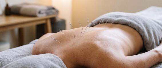 Fototapeta premium Relaxing back acupuncture treatment with needles in spa setting for pain relief and wellness