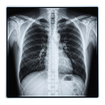 Human chest X-ray radiograph scan on transparent background