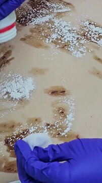 Professional removal of papillomas and moles with electrocoagulation procedure in dermatology clinic. overweight European woman on the surgical table. moles papillomas neoplasms on the body