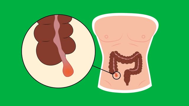 Medical vector animation illustrating appendicitis with an enlarged inflamed appendix. Educational digestive health concept for green background, diagnosis, treatment, and healthcare content.