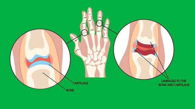 Medical vector animation illustrating arthritis with inflamed joints, cartilage damage, and bone changes. Educational rheumatology ,green background, treatment, and healthcare.