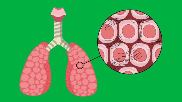 Medical vector animation illustrating asbestosis with affected lung tissue and magnified fibrotic changes. Educational respiratory health, green background, diagnosis, and healthcare 