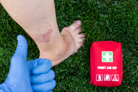 First Aid Assessment of Bruised Lower Leg Outdoors