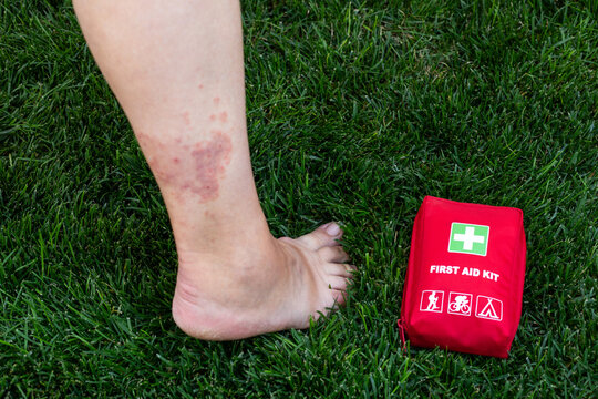 Bruised Leg Beside Red First Aid Kit on Grass