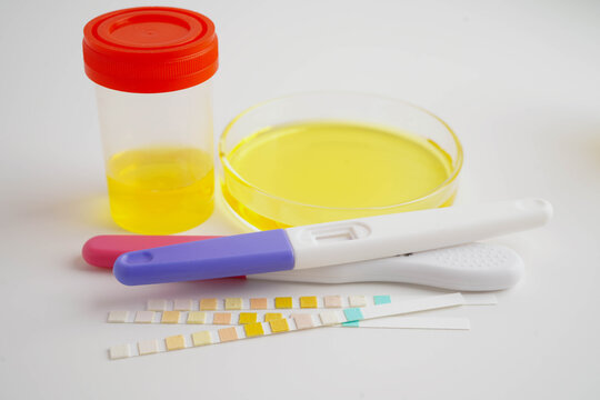Urinalysis, urine cup with reagent strip pH paper test and comparison chart in laboratory.