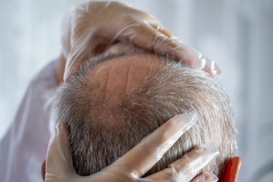 Mature bald man receiving hair restoration therapy specialized clinic, Male patient undergoing trichology treatment for androgenetic alopecia, Professional medical approach hair loss in men using