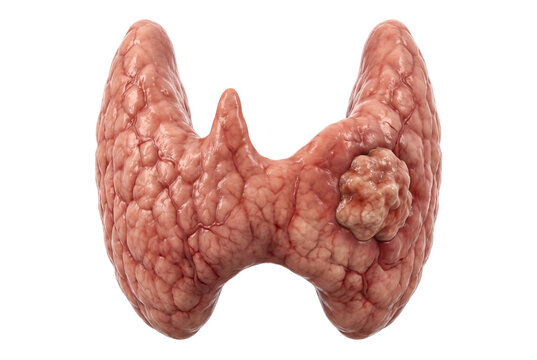 Detailed 3D medical illustration showing a thyroid gland with a localized irregular tumor mass within one lobe, illustrating thyroid nodule or thyroid cancer.
